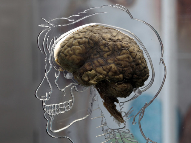 Spit test may diagnose, predict duration of concussion in children